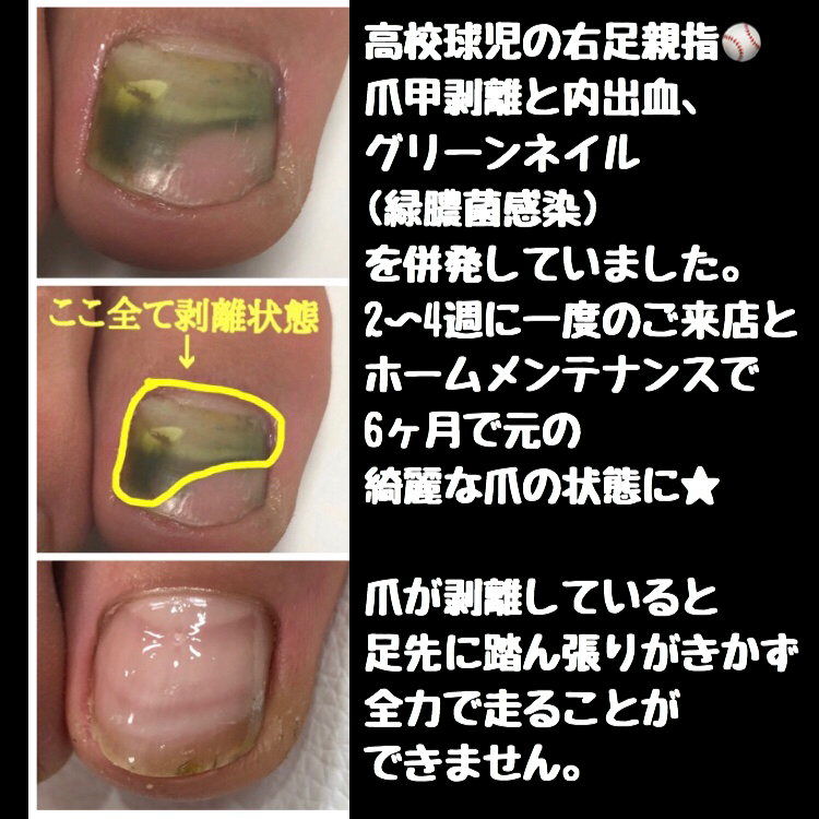 アスリートネイル 爪labo Bell Nail ベルネイル